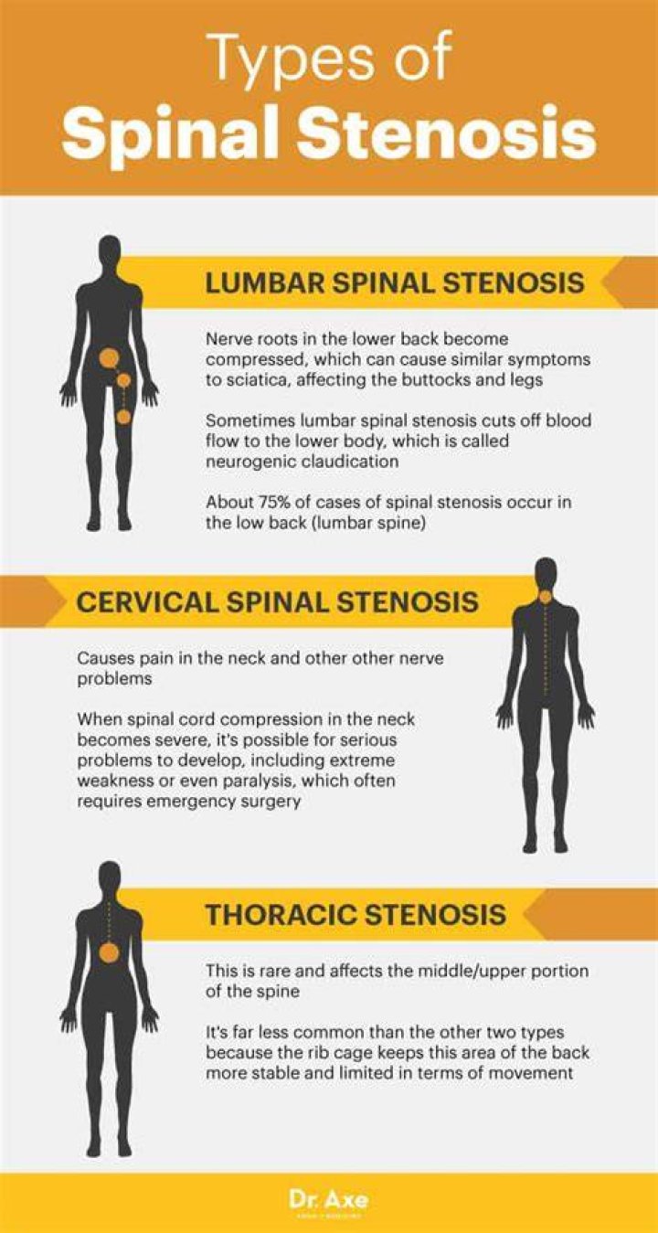 Spinal Stenosis Symptoms, Diagnosis & Treatment Miami Neuroscience Center